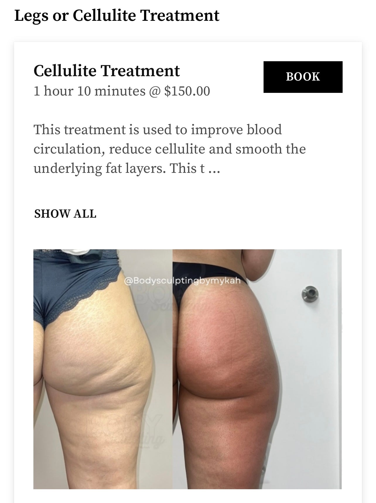 Legs or Cellulite - 1 Session